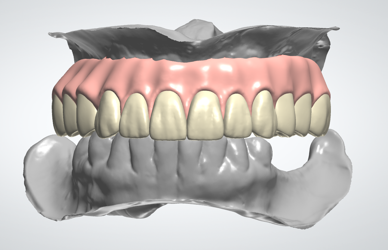 Gingiva Crown Design